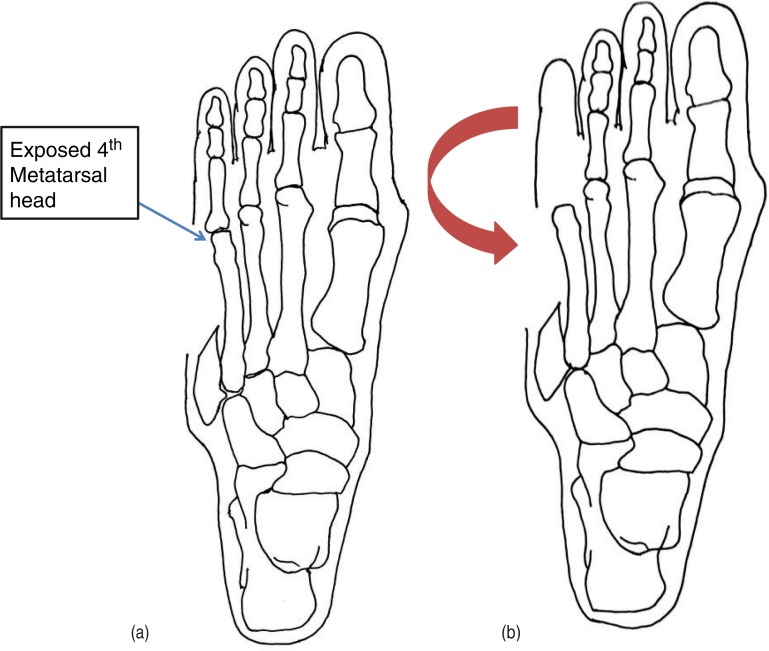 The lateral lesser toe fillet flap for diabetic foot soft tissue closure: surgical technique and case report.