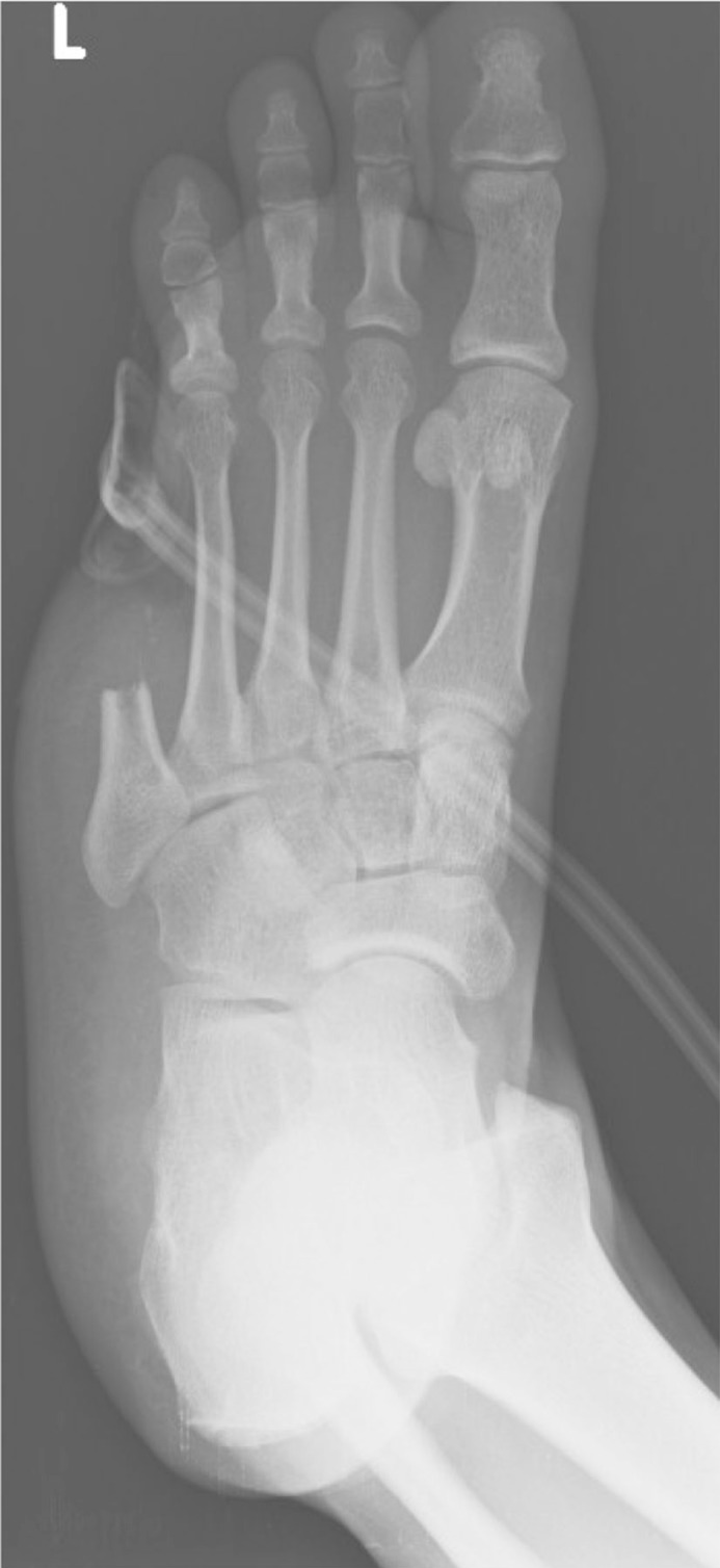 The lateral lesser toe fillet flap for diabetic foot soft tissue closure: surgical technique and case report.