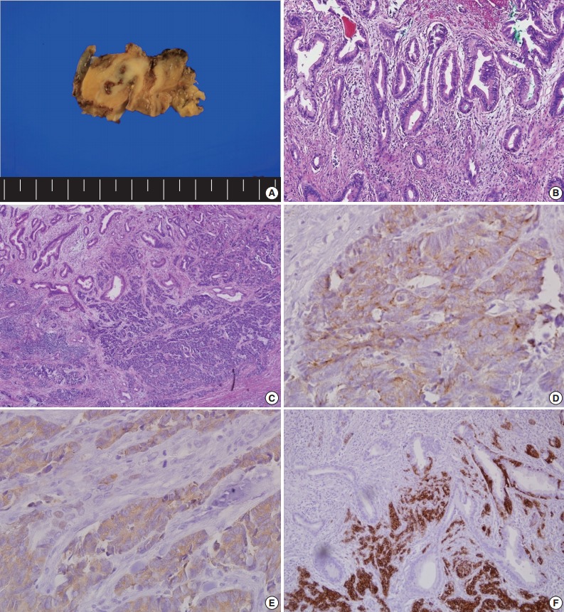 A case of mixed adenoneuroendocrine carcinoma of the common bile duct: initially diagnosed as cholangiocarcinoma.