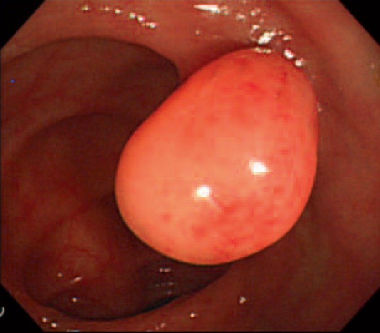 Endoscopic Removal of Pedunculated Leiomyoma of the Sigmoid Colon.