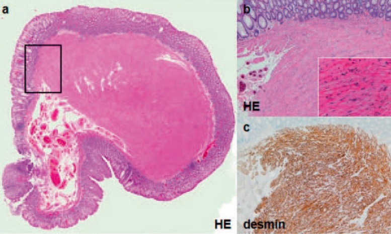 Endoscopic Removal of Pedunculated Leiomyoma of the Sigmoid Colon.