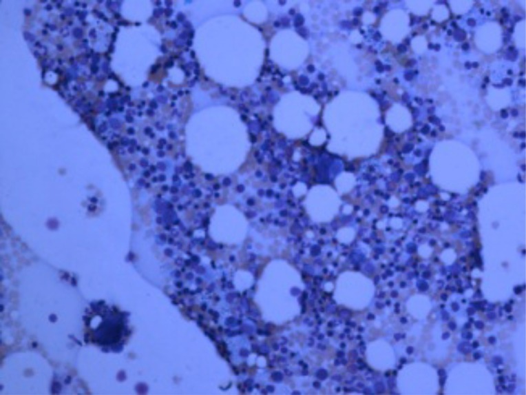 Felty's Syndrome, Insights and Updates.