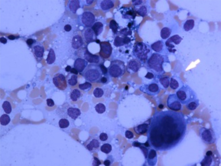 Felty's Syndrome, Insights and Updates.