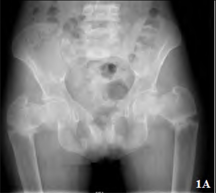 Sjögren's, Renal Tubular Acidosis And Osteomalacia - An Asian Indian Series.