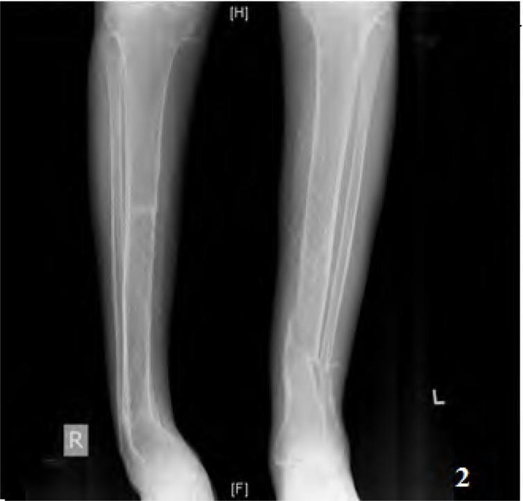 Sjögren's, Renal Tubular Acidosis And Osteomalacia - An Asian Indian Series.