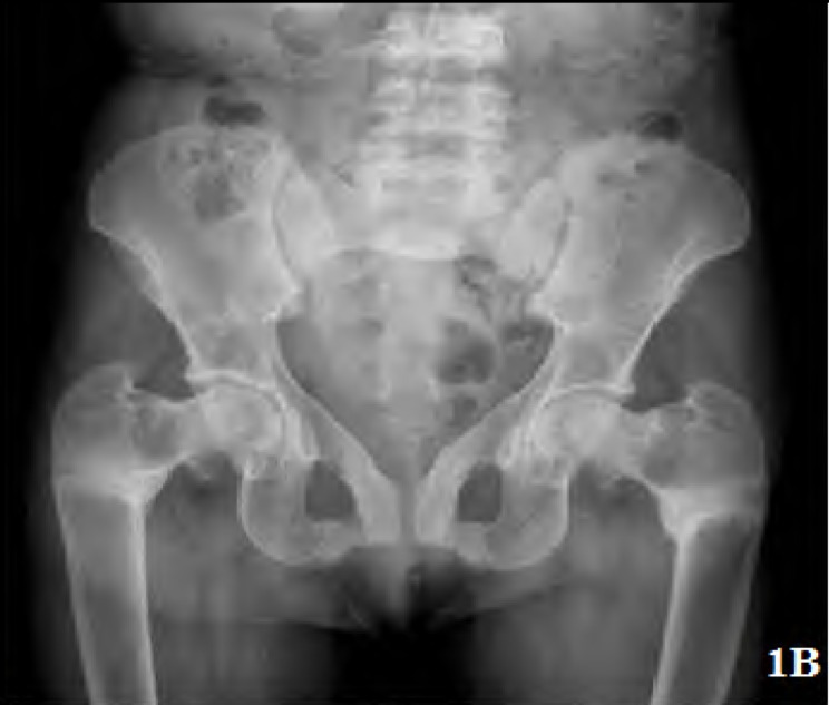 Sjögren's, Renal Tubular Acidosis And Osteomalacia - An Asian Indian Series.