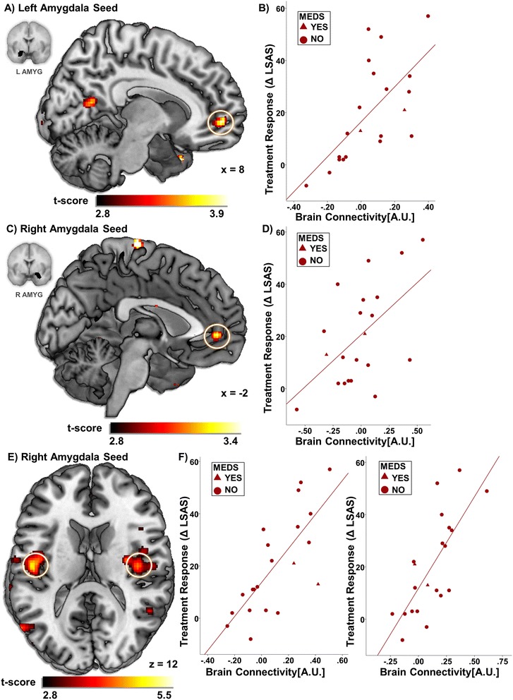 Resting state amygdala-prefrontal connectivity predicts symptom change after cognitive behavioral therapy in generalized social anxiety disorder.