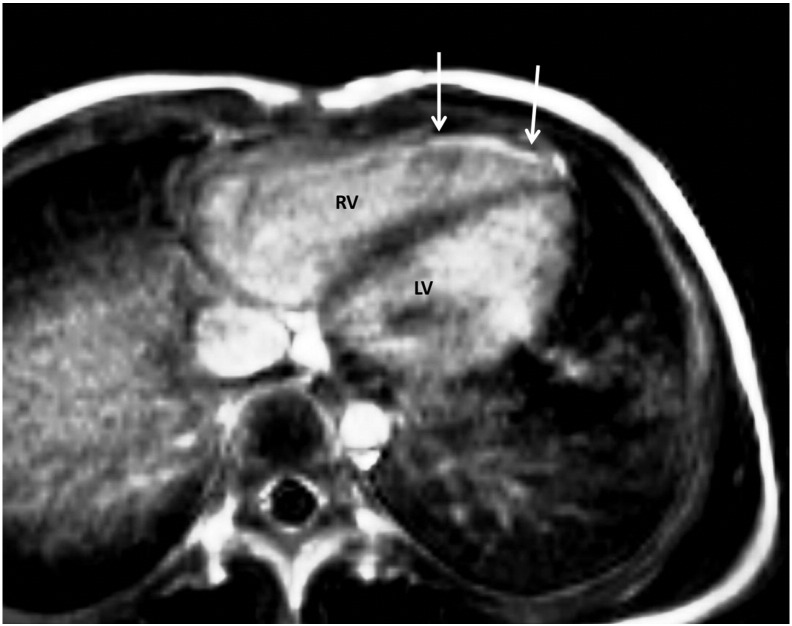 Late gadolinium enhancement (LGE) progresses with right ventricle volume in children after repair of tetralogy of fallot