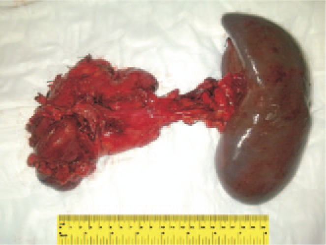 Pancreatic pseudocyst or a cystic tumor of the pancreas?