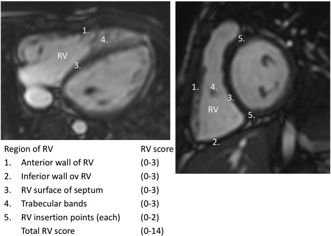 Late gadolinium enhancement (LGE) progresses with right ventricle volume in children after repair of tetralogy of fallot