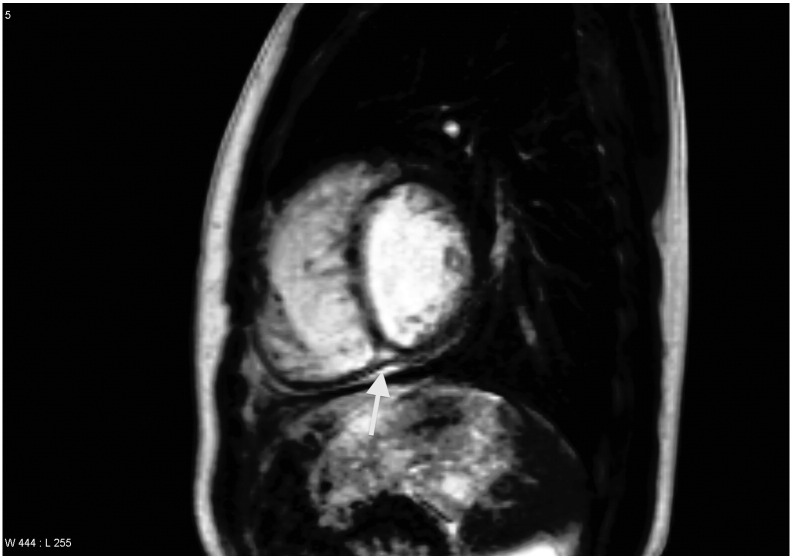 Late gadolinium enhancement (LGE) progresses with right ventricle volume in children after repair of tetralogy of fallot