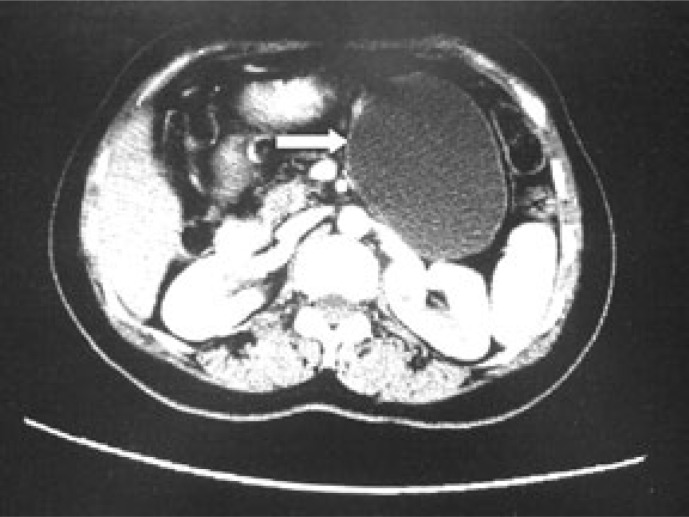 Pancreatic pseudocyst or a cystic tumor of the pancreas?