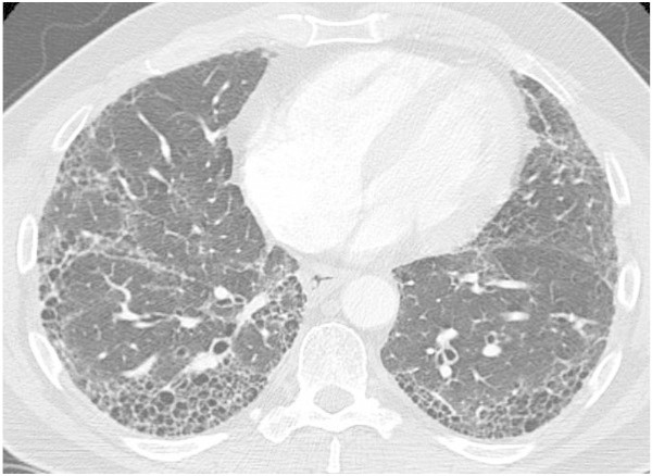 Diagnosis and management of interstitial lung disease.