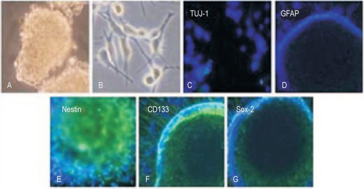 Enhanced MGMT expression contributes to temozolomide resistance in glioma stem-like cells.