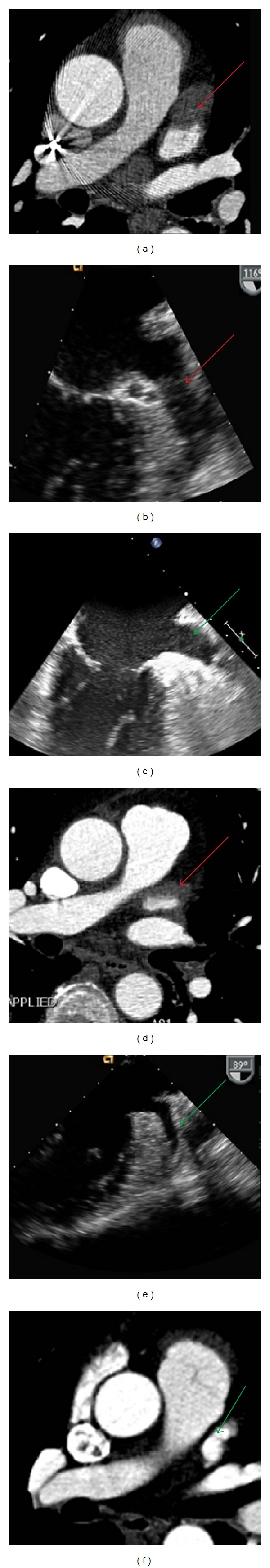 Exclusion of left atrial appendage thrombus using single phase coronary computed tomography as compared to transesophageal echocardiography in patients undergoing pulmonary vein isolation.