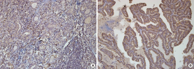 P2X7 Receptor Expression in Coexistence of Papillary Thyroid Carcinoma with Hashimoto's Thyroiditis.