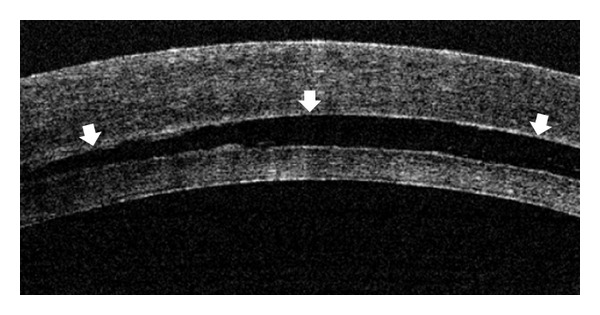 Efficacy of Intraoperative Anterior Segment Optical Coherence Tomography during Descemet's Stripping Automated Endothelial Keratoplasty.