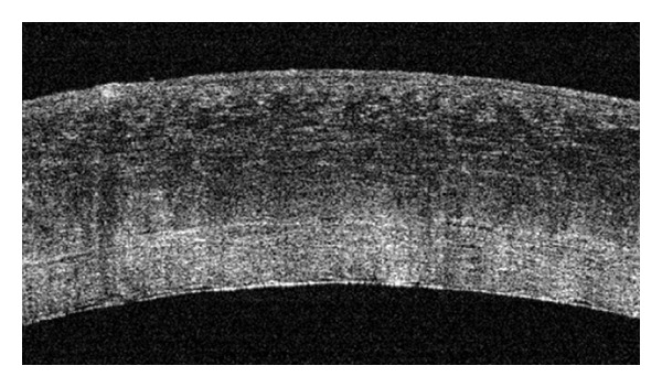 Efficacy of Intraoperative Anterior Segment Optical Coherence Tomography during Descemet's Stripping Automated Endothelial Keratoplasty.