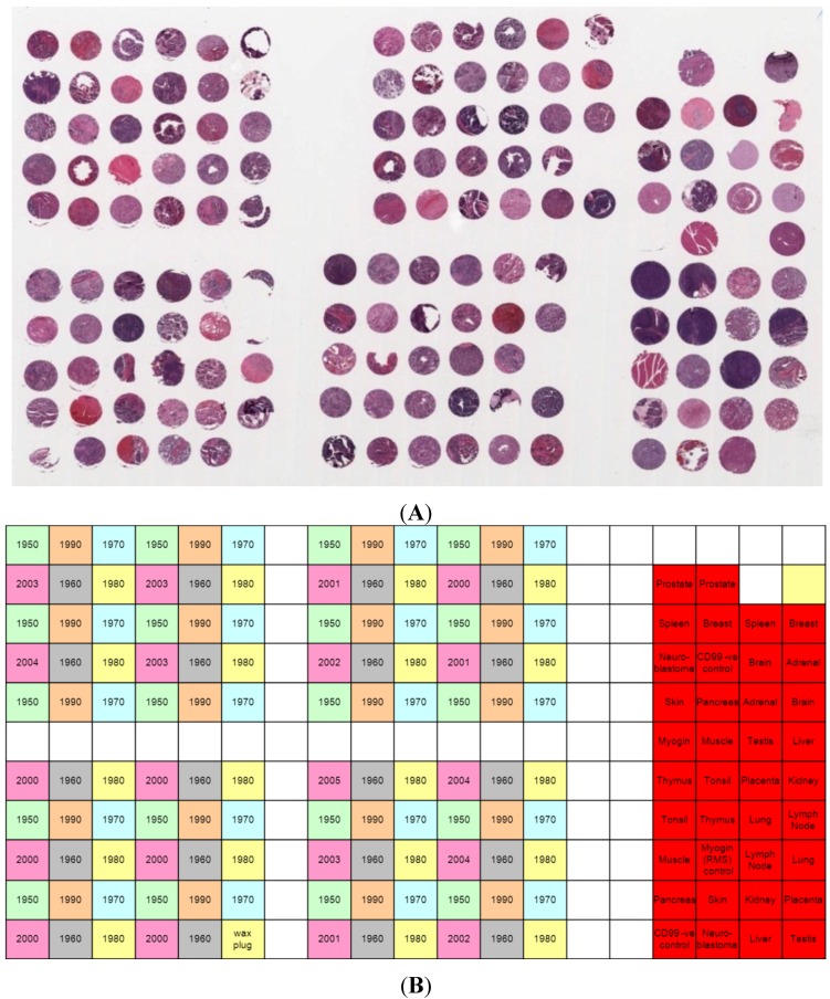 Can Archival Tissue Reveal Answers to Modern Research Questions?: Computer-Aided Histological Assessment of Neuroblastoma Tumours Collected over 60 Years.