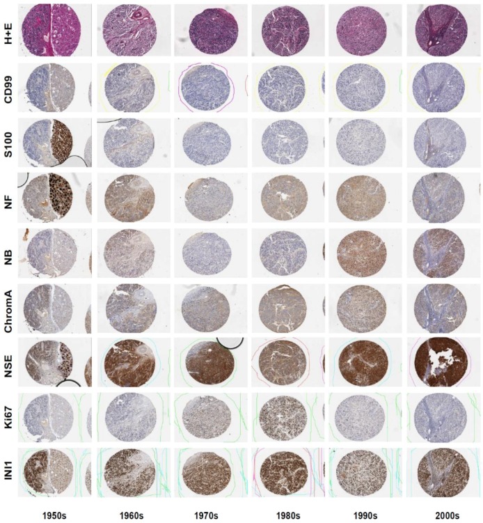 Can Archival Tissue Reveal Answers to Modern Research Questions?: Computer-Aided Histological Assessment of Neuroblastoma Tumours Collected over 60 Years.
