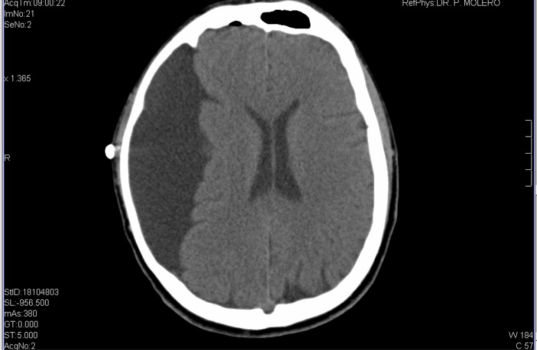 A schizophrenia-like psychotic disorder secondary to an arachnoid cyst remitted with neurosurgical treatment of the cyst.