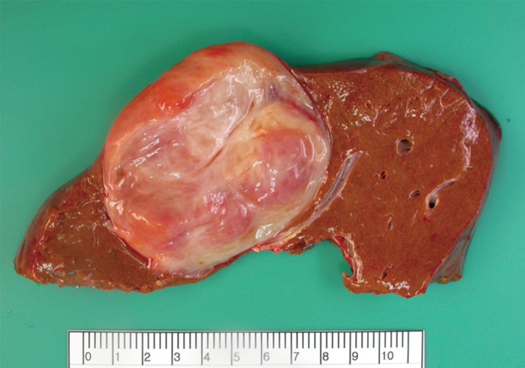 Primary myxoid leiomyoma of the liver.