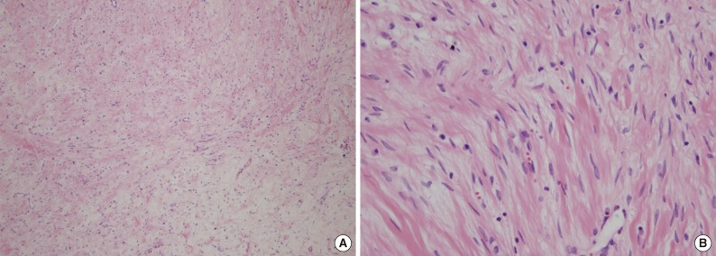 Primary myxoid leiomyoma of the liver.