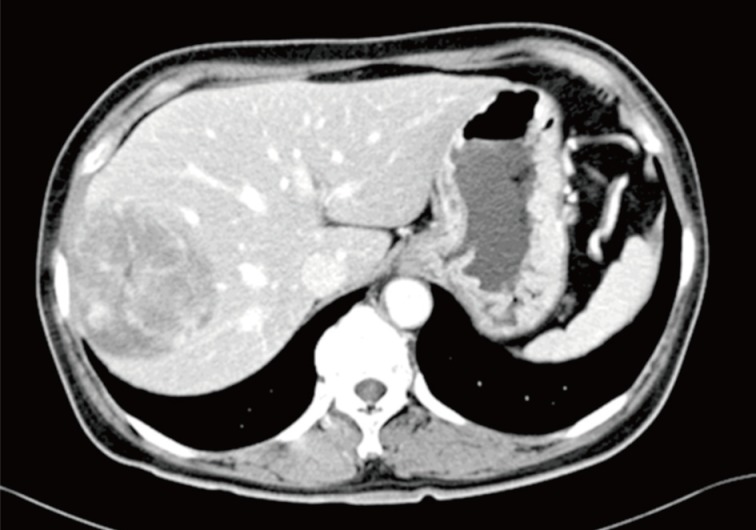 Primary myxoid leiomyoma of the liver.