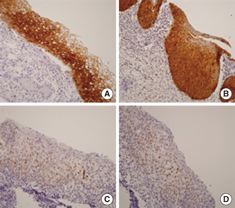 Distribution of Human Papillomavirus 52 and 58 Genotypes, and Their Expression of p16 and p53 in Cervical Neoplasia.