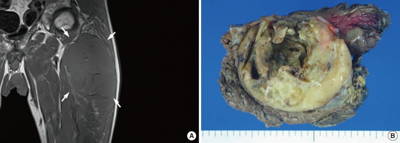 Malignant fat-forming solitary fibrous tumor of the thigh.