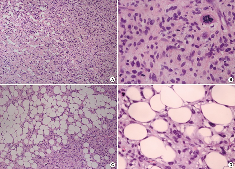 Malignant fat-forming solitary fibrous tumor of the thigh.