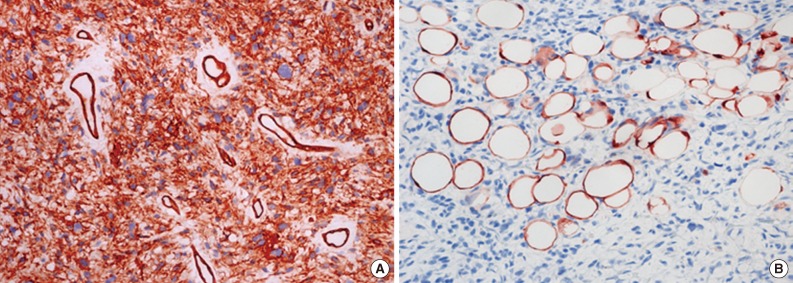 Malignant fat-forming solitary fibrous tumor of the thigh.