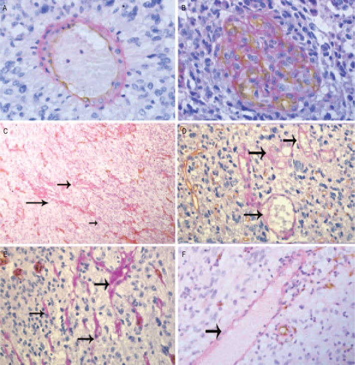 Vasculogenic mimicry: a novel target for glioma therapy.