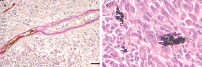 Vasculogenic mimicry: a novel target for glioma therapy.