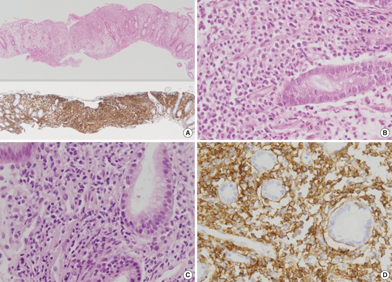 Benign Indolent CD56-Positive NK-Cell Lymphoproliferative Lesion Involving Gastrointestinal Tract in an Adolescent.