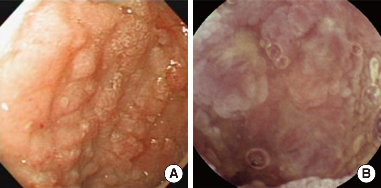 Benign Indolent CD56-Positive NK-Cell Lymphoproliferative Lesion Involving Gastrointestinal Tract in an Adolescent.