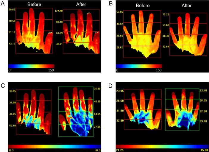 Application of dynamic indocyanine green perfusion imaging for evaluation of vasoactive effect of acupuncture: a preliminary follow-up study on normal healthy volunteers.