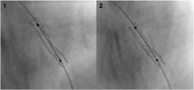 Efficacy of non-compliant balloon post-dilation in optimization of contemporary stents: A digital stent enhancement study