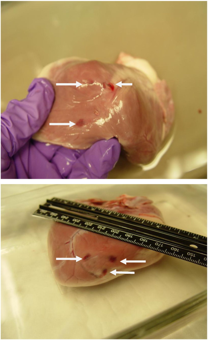 Facilitation of transvenous lead extraction using site-specific delivery of electrosurgical energy