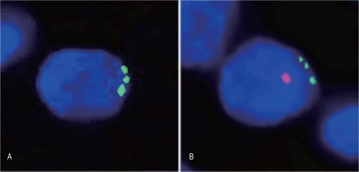 Fusion of bone marrow-derived cells with cancer cells: metastasis as a secondary disease in cancer.