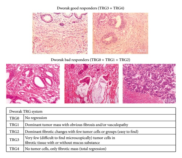 Prognostic value of mandard and dworak tumor regression grading in rectal cancer: study of a single tertiary center.