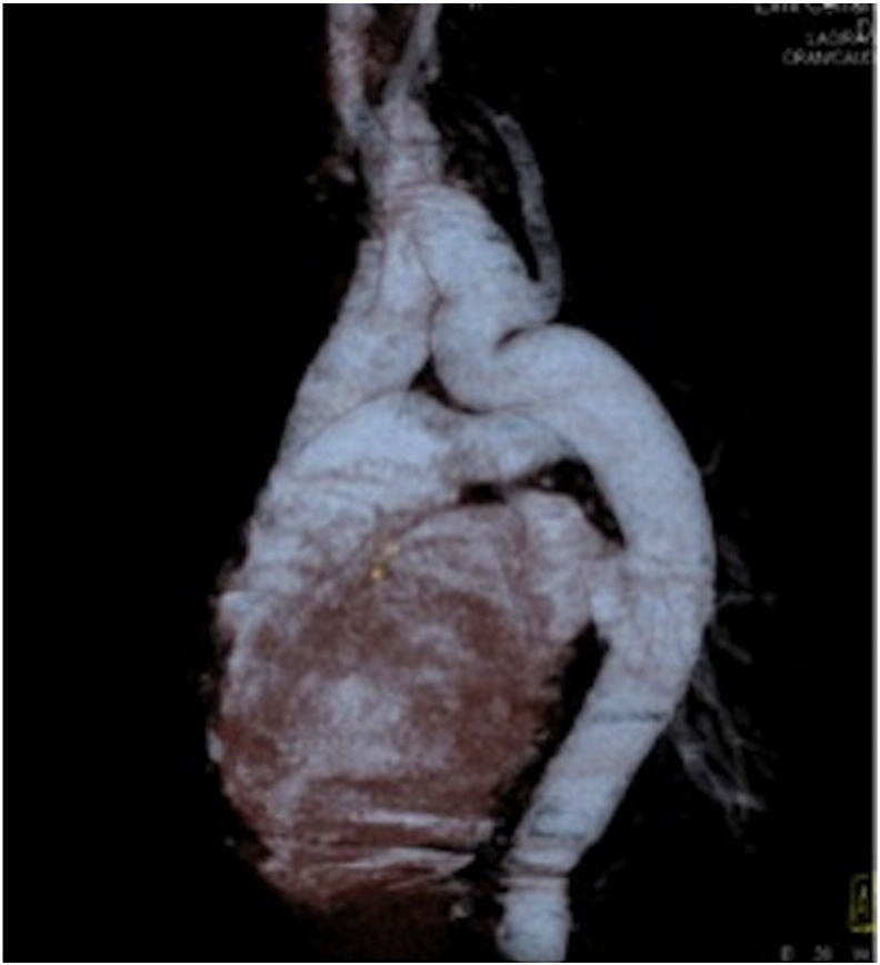 Kinking of the aorta with calcified aortic valve stenosis: A case report