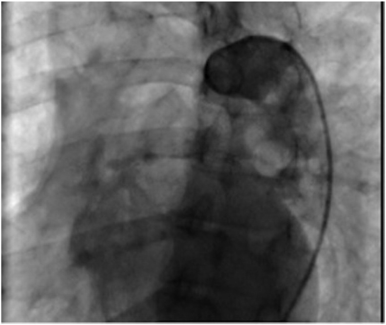 Kinking of the aorta with calcified aortic valve stenosis: A case report