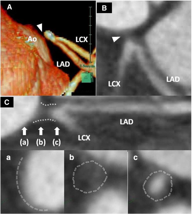 Isolated left coronary ostial occlusion detected by multislice computed tomography