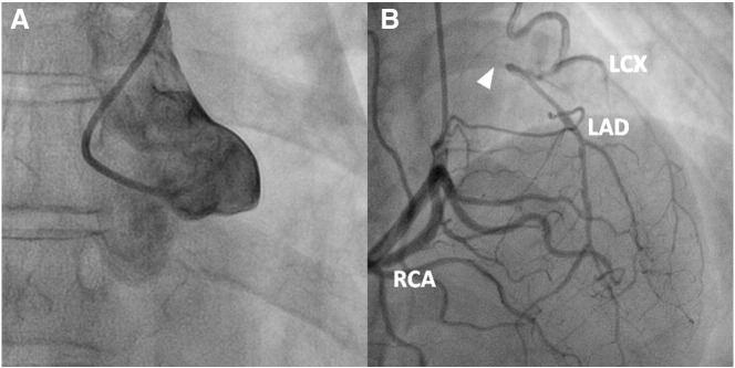 Isolated left coronary ostial occlusion detected by multislice computed tomography