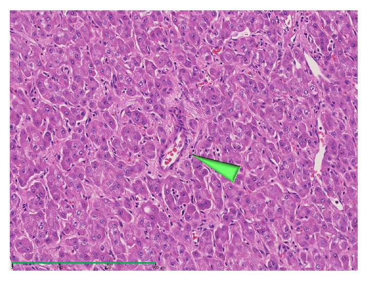 Tumor Hemodynamics and Hepatocarcinogenesis: Radio-Pathological Correlations and Outcomes of Carcinogenic Hepatocyte Nodules.