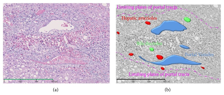 Tumor Hemodynamics and Hepatocarcinogenesis: Radio-Pathological Correlations and Outcomes of Carcinogenic Hepatocyte Nodules.