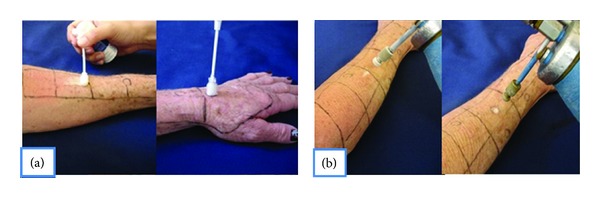 Histological comparison of two cryopeeling methods for photodamaged skin.