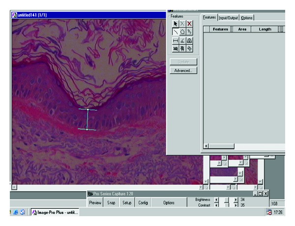 Histological comparison of two cryopeeling methods for photodamaged skin.