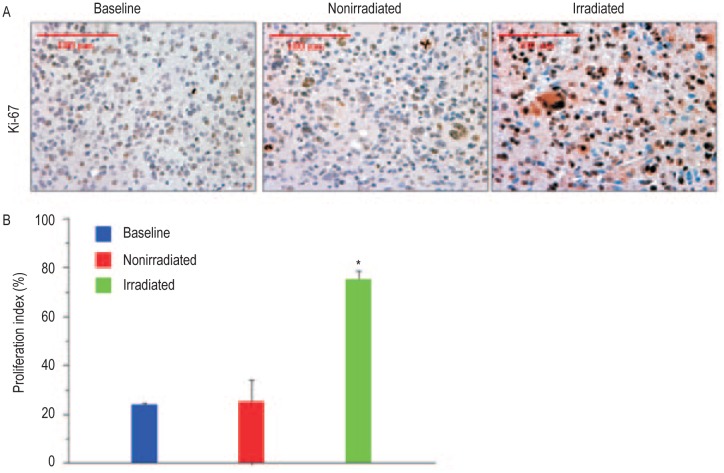 Subcurative radiation significantly increases cell proliferation, invasion, and migration of primary glioblastoma multiforme in vivo.